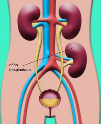 kidney_transplant